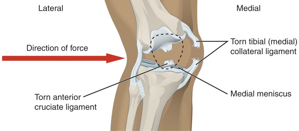 Déchirure ligamentaire du genou